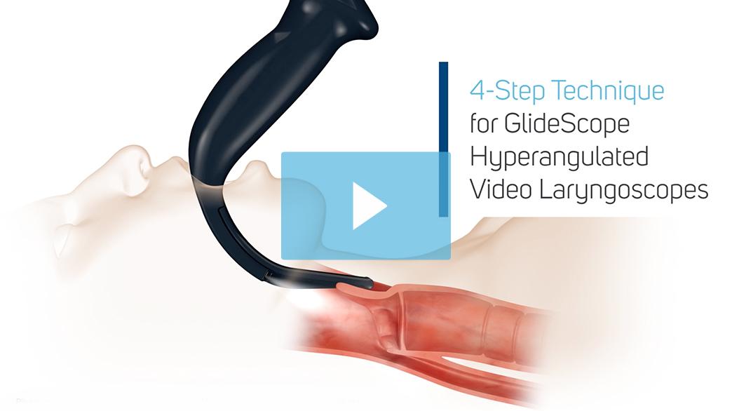 4-step-technique-glidescope-intubation